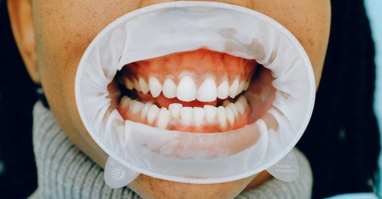 What You Need To Know About Teeth Whitening